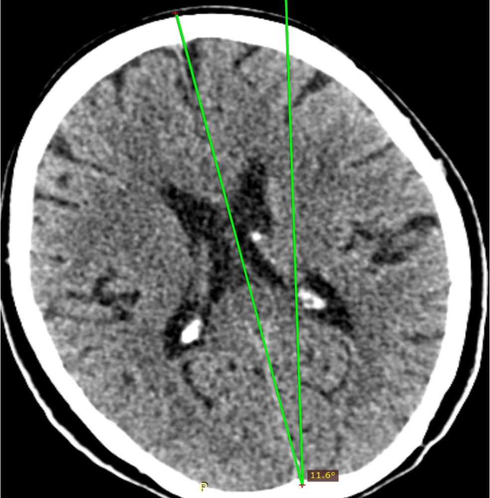 颅脑CT偏斜角度测量